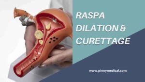 Raspa Price in Philippines 2024: Dilation and Curettage (D and C).